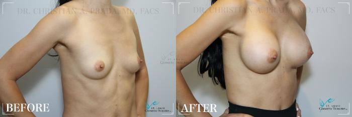 Before & After Breast Augmentation Case 230 Right Oblique View in St. Louis, MO
