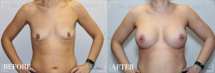 Before & After Breast Augmentation Case 232 Front View in St. Louis, MO