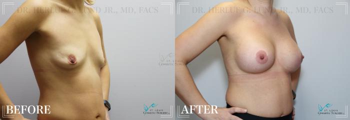 Before & After Breast Augmentation Case 232 Right Oblique View in St. Louis, MO