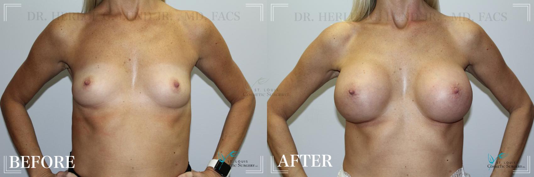 Before & After Breast Augmentation Case 234 Front View in St. Louis, MO
