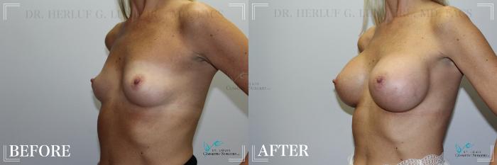 Before & After Breast Augmentation Case 234 Left Oblique View in St. Louis, MO