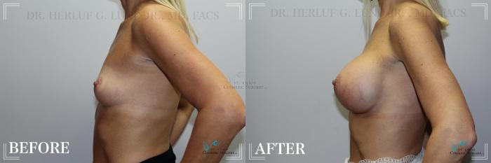 Before & After Breast Augmentation Case 234 Left Side View in St. Louis, MO
