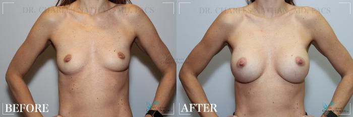 Before & After Breast Augmentation Case 235 Front View in St. Louis, MO