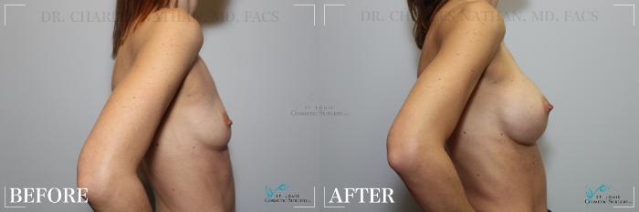 Before & After Breast Augmentation Case 235 Right Side View in St. Louis, MO