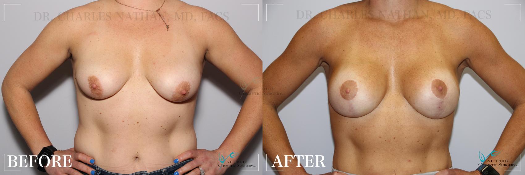 Before & After Breast Augmentation Case 237 Front View in St. Louis, MO