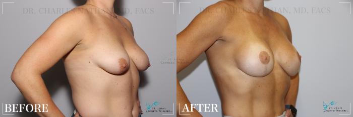 Before & After Breast Augmentation Case 237 Right Oblique View in St. Louis, MO