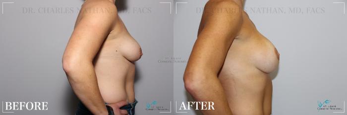 Before & After Breast Augmentation Case 237 Right Side View in St. Louis, MO