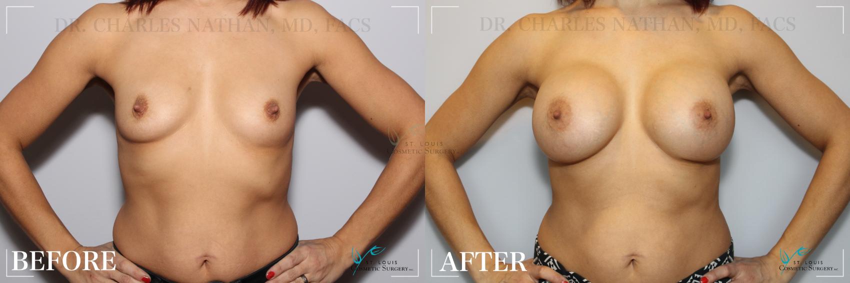 Before & After Breast Augmentation Case 238 Front View in St. Louis, MO