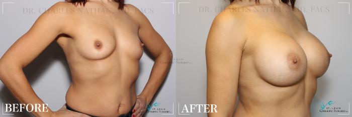 Before & After Breast Augmentation Case 238 Right Oblique View in St. Louis, MO