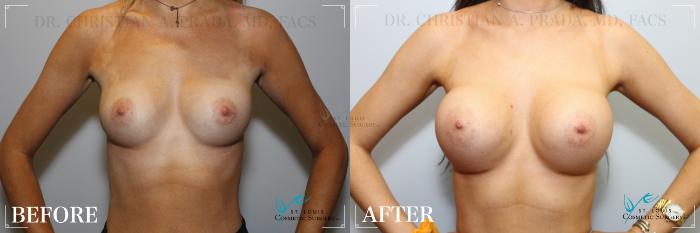 Before & After Breast Augmentation Case 239 Front View in St. Louis, MO
