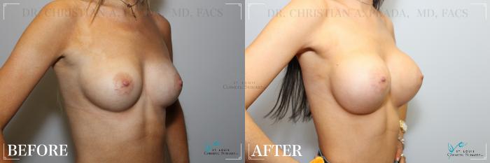 Before & After Breast Augmentation Case 239 Left Oblique View in St. Louis, MO