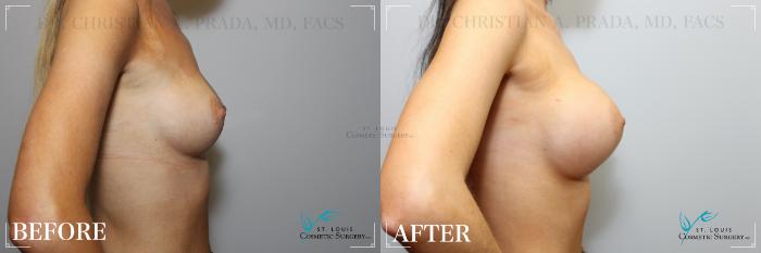 Before & After Breast Augmentation Case 239 Left Side View in St. Louis, MO