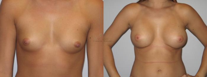 Before & After Breast Augmentation Case 24 View #1 View in St. Louis, MO