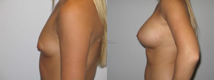 Before & After Breast Augmentation Case 24 View #2 View in St. Louis, MO