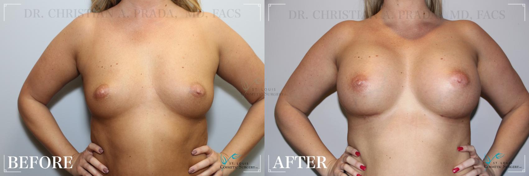 Before & After Breast Augmentation Case 240 Front View in St. Louis, MO