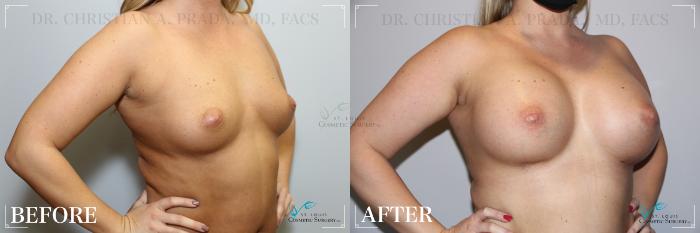 Before & After Breast Augmentation Case 240 Left Oblique View in St. Louis, MO