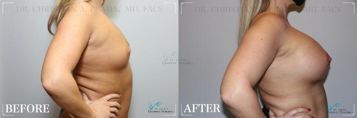 Before & After Breast Augmentation Case 240 Left Side View in St. Louis, MO