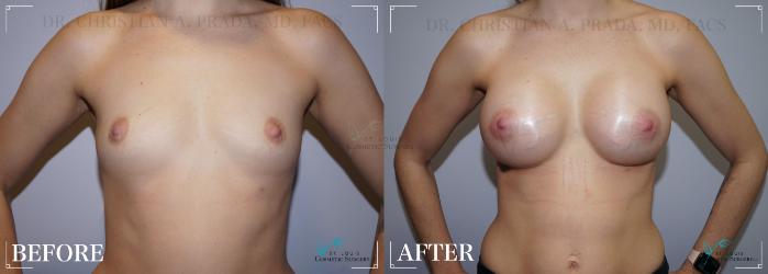 Before & After Breast Augmentation Case 241 Front View in St. Louis, MO