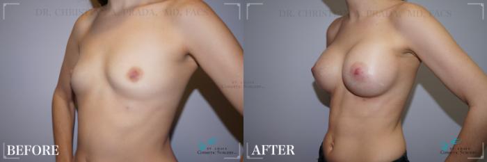 Before & After Breast Augmentation Case 241 Left Oblique View in St. Louis, MO