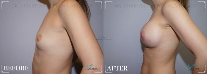 Before & After Breast Augmentation Case 241 Left Side View in St. Louis, MO