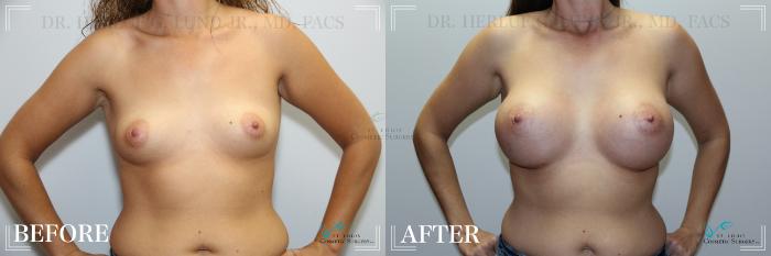 Before & After Breast Augmentation Case 244 Front View in St. Louis, MO