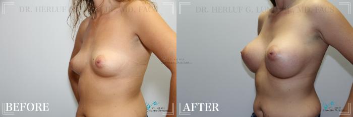 Before & After Breast Augmentation Case 244 Left Oblique View in St. Louis, MO