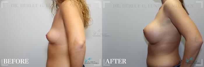 Before & After Breast Augmentation Case 244 Left Side View in St. Louis, MO