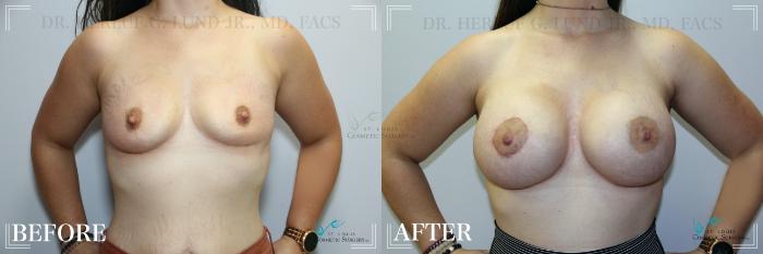 Before & After Breast Augmentation Case 245 Front View in St. Louis, MO