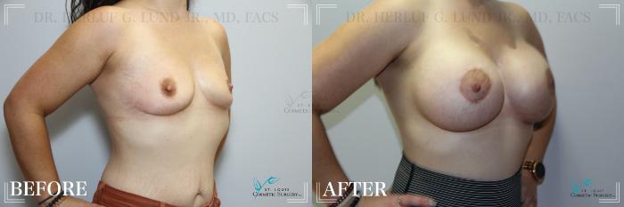 Before & After Breast Augmentation Case 245 Right Oblique View in St. Louis, MO