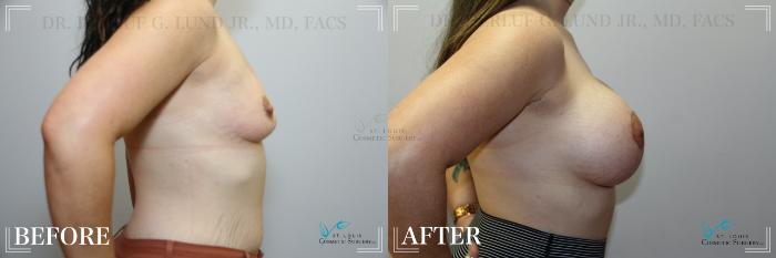 Before & After Breast Augmentation Case 245 Right Side View in St. Louis, MO
