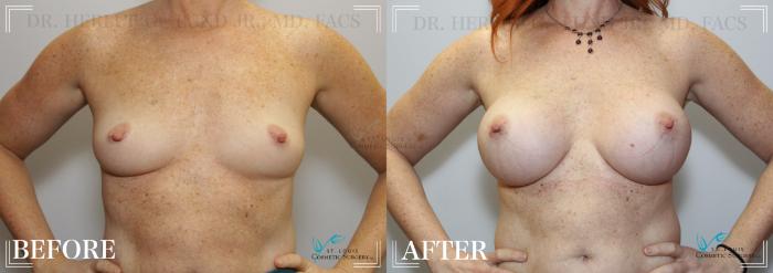 Before & After Breast Augmentation Case 248 Front View in St. Louis, MO