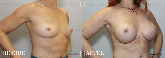 Before & After Breast Augmentation Case 248 Right Oblique View in St. Louis, MO