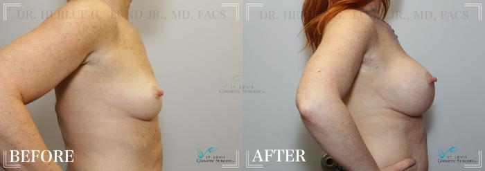 Before & After Breast Augmentation Case 248 Right Side View in St. Louis, MO