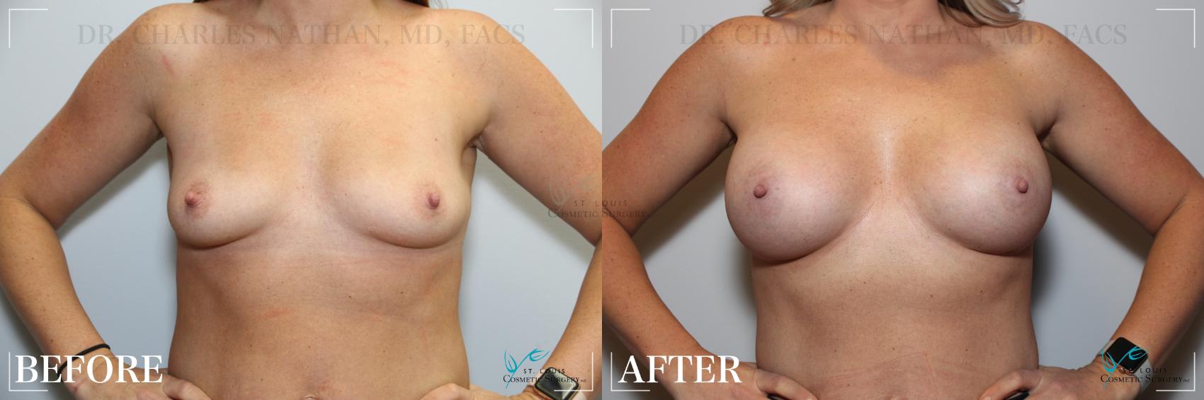 Before & After Breast Augmentation Case 249 Front View in St. Louis, MO