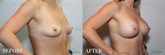 Before & After Breast Augmentation Case 249 Right Oblique View in St. Louis, MO