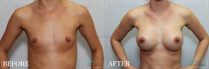Before & After Breast Augmentation Case 252 Front View in St. Louis, MO