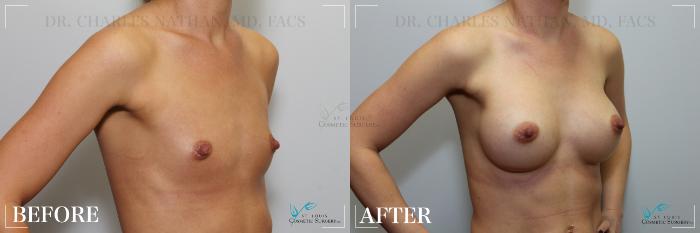 Before & After Breast Augmentation Case 252 Right Oblique View in St. Louis, MO