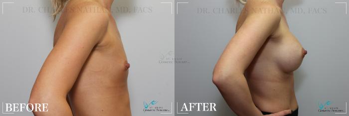 Before & After Breast Augmentation Case 252 Right Side View in St. Louis, MO