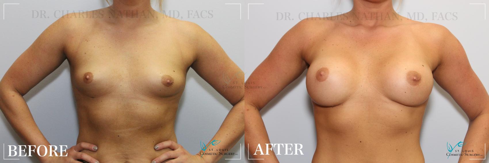 Before & After Breast Augmentation Case 253 Front View in St. Louis, MO