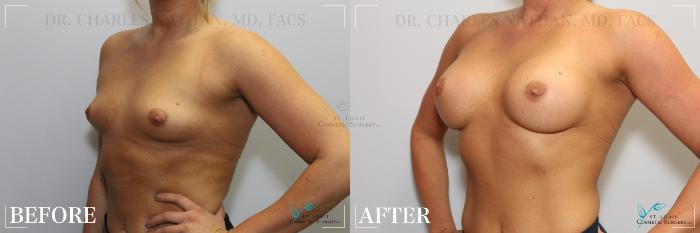 Before & After Breast Augmentation Case 253 Left Oblique View in St. Louis, MO