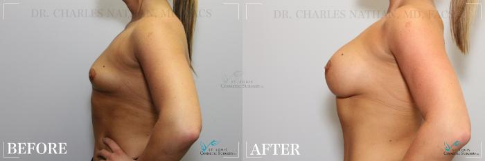 Before & After Breast Augmentation Case 253 Left Side View in St. Louis, MO