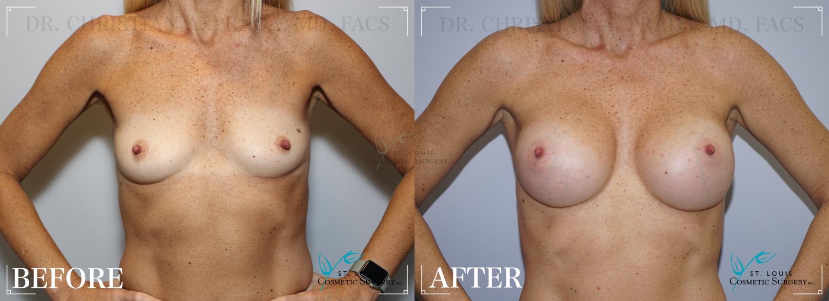 Before & After Breast Augmentation Case 254 Front View in St. Louis, MO