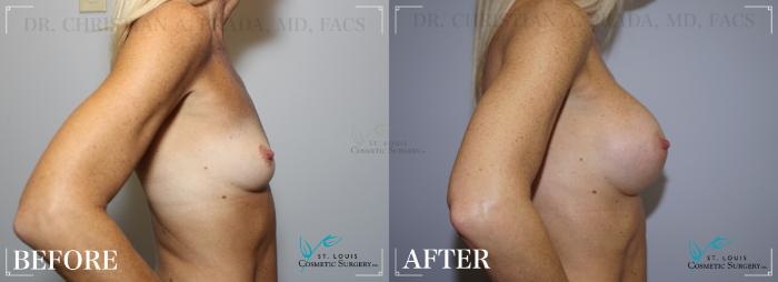 Before & After Breast Augmentation Case 254 Left Side View in St. Louis, MO