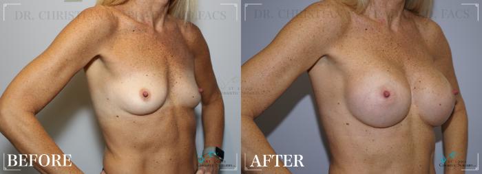 Before & After Breast Augmentation Case 254 Right Oblique View in St. Louis, MO