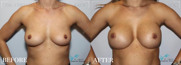 Before & After Breast Augmentation Case 255 Front View in St. Louis, MO