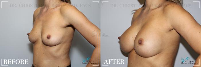 Before & After Breast Augmentation Case 255 Left Oblique View in St. Louis, MO
