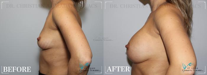 Before & After Breast Augmentation Case 255 Left Side View in St. Louis, MO