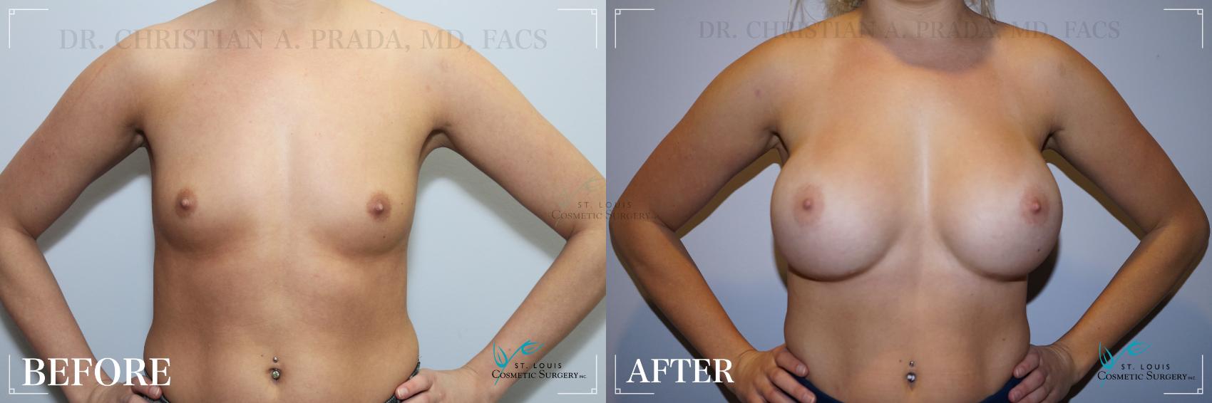 Before & After Breast Augmentation Case 257 Front View in St. Louis, MO