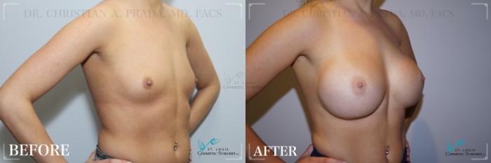 Before & After Breast Augmentation Case 257 Right Oblique View in St. Louis, MO