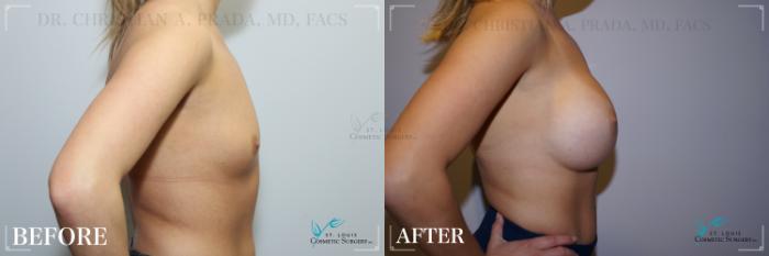 Before & After Breast Augmentation Case 257 Right Side View in St. Louis, MO